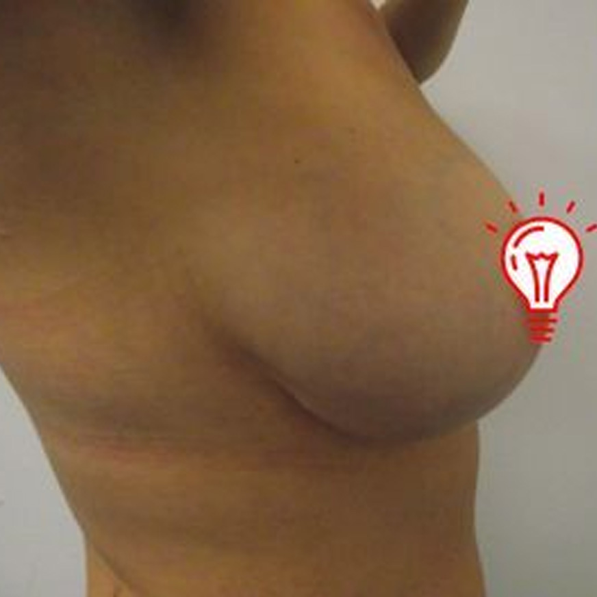 Non-Invasive Breast Reduction - USA Ultra Slim